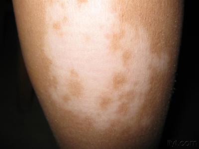 白癜风图片 白癜风图片